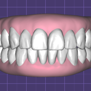 Teeth in Occlusion with Virtual Gingiva Libraries by Fernando Polanco