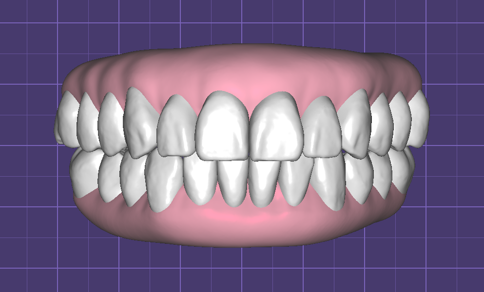 Teeth in Occlusion with Virtual Gingiva Libraries by Fernando Polanco