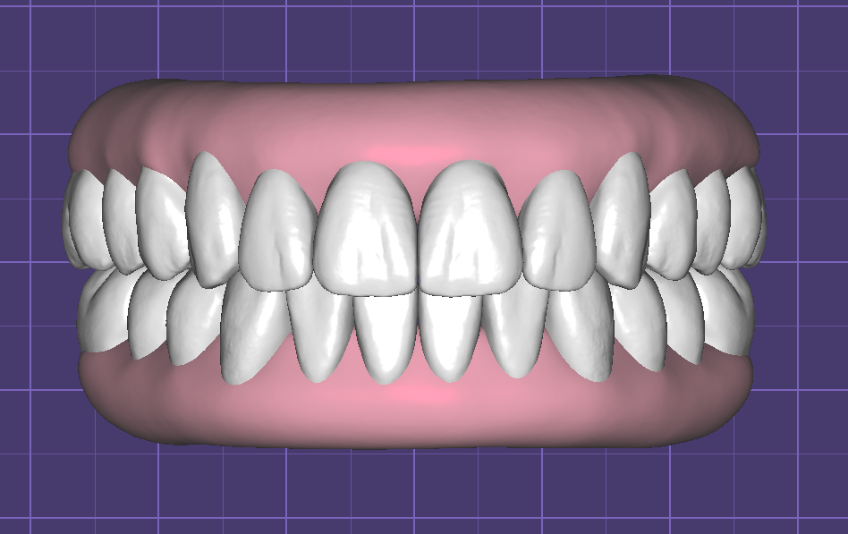 Teeth in Occlusion with Virtual Gingiva Libraries by Fernando Polanco - Image 9