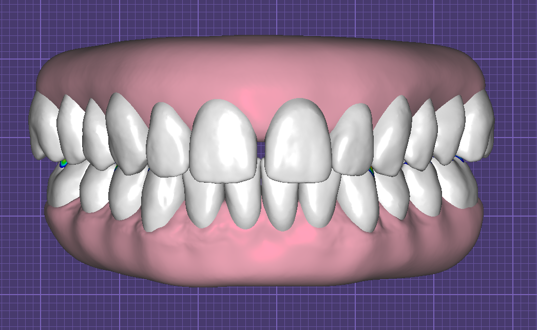 Teeth in Occlusion with Virtual Gingiva Libraries by Fernando Polanco - Image 8