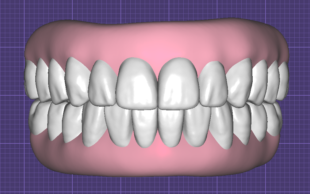 Teeth in Occlusion with Virtual Gingiva Libraries by Fernando Polanco - Image 7