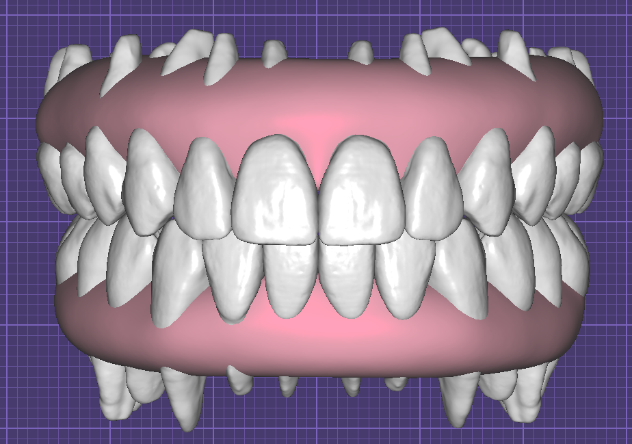 Teeth in Occlusion with Virtual Gingiva Libraries by Fernando Polanco - Image 6