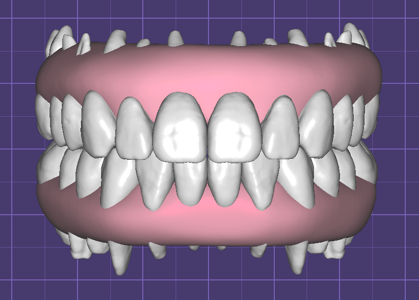 Teeth in Occlusion with Virtual Gingiva Libraries by Fernando Polanco - Image 5