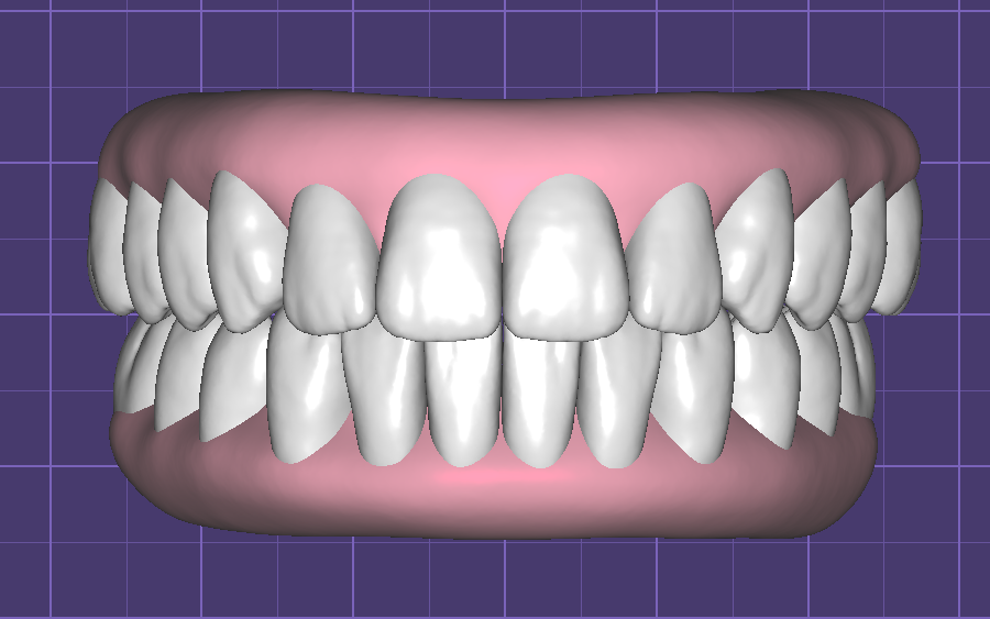 Teeth in Occlusion with Virtual Gingiva Libraries by Fernando Polanco - Image 4