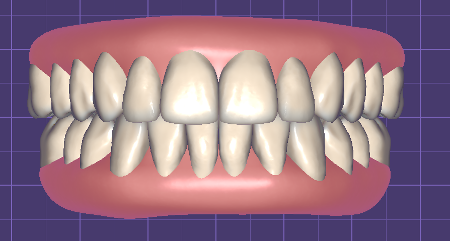 Teeth in Occlusion with Virtual Gingiva Libraries by Fernando Polanco - Image 3
