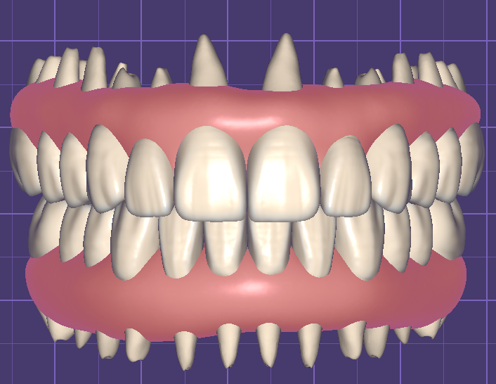 Teeth in Occlusion with Virtual Gingiva Libraries by Fernando Polanco - Image 2